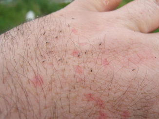 muggenbeetbehandeling zwelling verwijderen